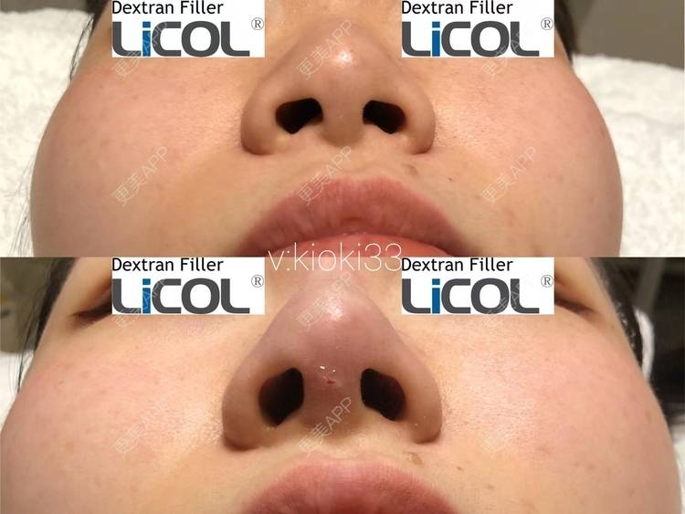 更美 - kioki33的鼻部多项经验 | 鼻翼缩小 | 鼻孔矫正 | 鼻部多项 | 西安