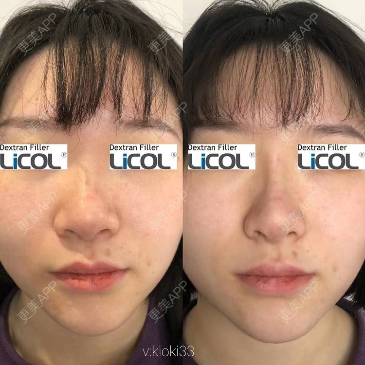 更美 - kioki33的鼻部多项经验 | 鼻翼缩小 | 鼻孔矫正 | 鼻部多项 | 西安