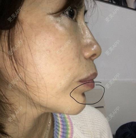 更美 - 更美用户X6u7ZrZMyz的膨体垫下巴经验 | 膨体垫下巴 | 视频日记