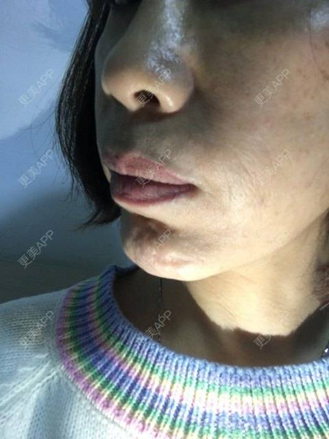 更美 - 更美用户X6u7ZrZMyz的膨体垫下巴经验 | 膨体垫下巴 | 视频日记