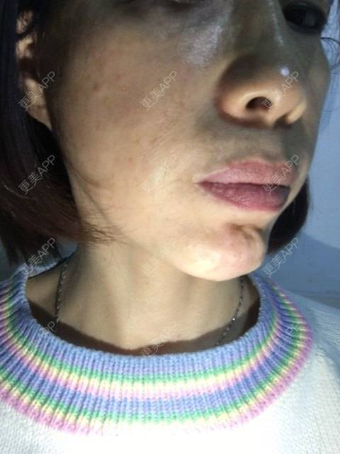 更美 - 更美用户X6u7ZrZMyz的膨体垫下巴经验 | 膨体垫下巴 | 视频日记