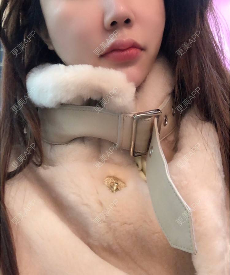 更美 - 柠檬汁拌匀的玻尿酸鼻部经验 | 玻尿酸鼻部 | 武汉