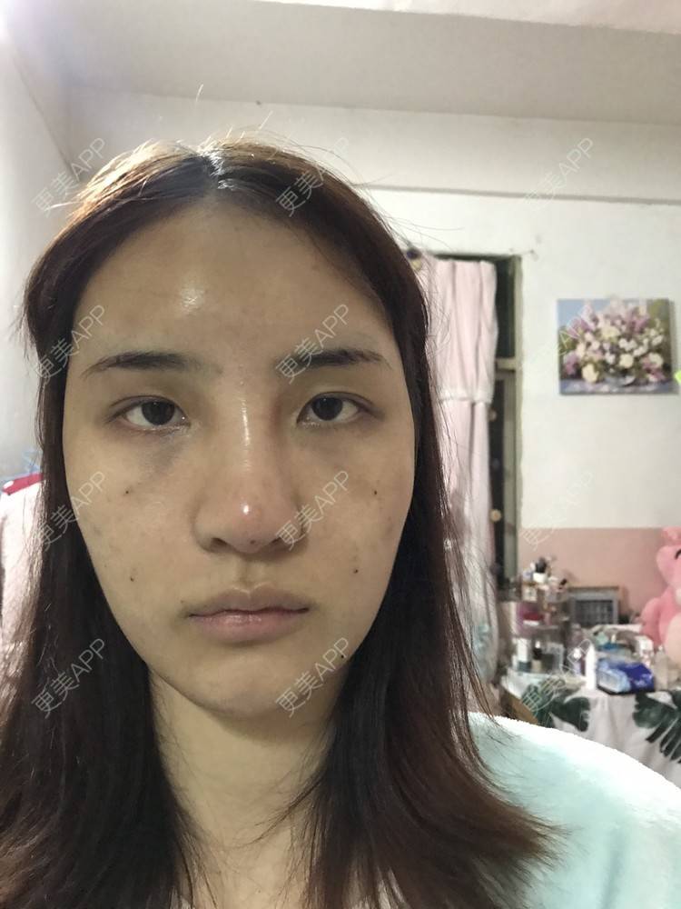 更美 - •你的小可爱•的自体脂肪垫下巴经验 | 自体脂肪垫下巴 | 自体脂肪丰太阳穴 | 深圳 | 自体脂肪垫鼻基底 | 玻尿酸溶解酶