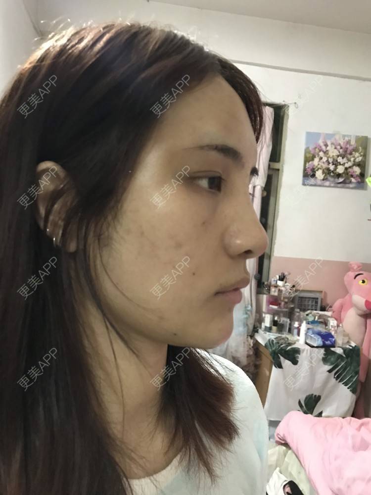 更美 - •你的小可爱•的自体脂肪垫下巴经验 | 自体脂肪垫下巴 | 自体脂肪丰太阳穴 | 深圳 | 自体脂肪垫鼻基底 | 玻尿酸溶解酶