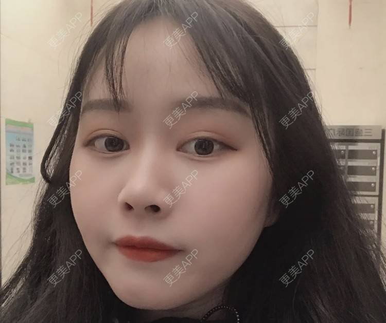 更美 - 更美用户ZJLNb5cWbs的光纤瘦脸经验 | 光纤瘦脸 | 南京