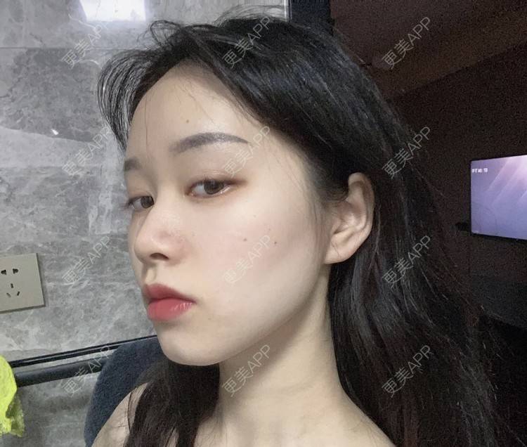 更美 - 更美用户ZJLNb5cWbs的光纤瘦脸经验 | 光纤瘦脸 | 南京