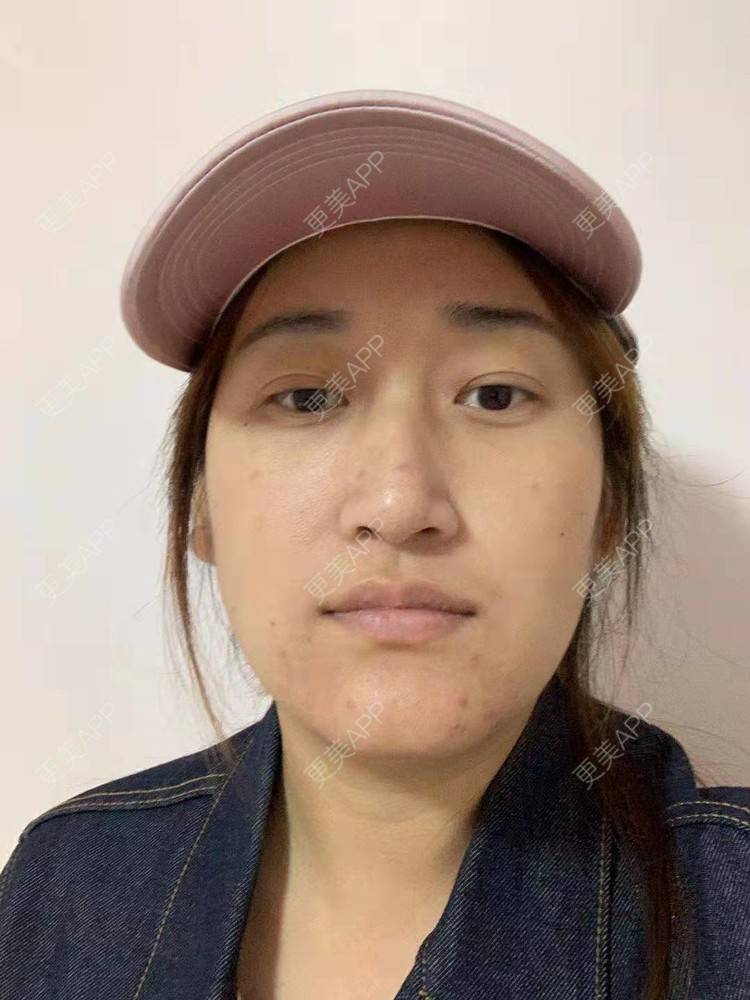 更美 - 更美用户ATliTAq8jn的内切去眼袋经验 | 北京 | 眶隔脂肪释放 | 射频去眼袋 | 内切去眼袋 | 激光去眼袋