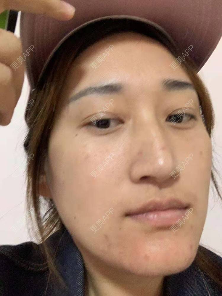 更美 - 更美用户ATliTAq8jn的内切去眼袋经验 | 北京 | 眶隔脂肪释放 | 射频去眼袋 | 内切去眼袋 | 激光去眼袋