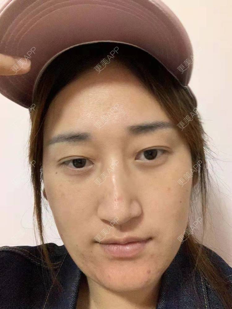 更美 - 更美用户ATliTAq8jn的内切去眼袋经验 | 北京 | 眶隔脂肪释放 | 射频去眼袋 | 内切去眼袋 | 激光去眼袋