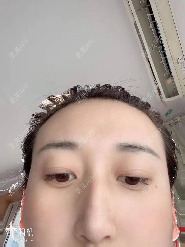 更美 - 更美用户ATliTAq8jn的内切去眼袋经验 | 北京 | 眶隔脂肪释放 | 射频去眼袋 | 内切去眼袋 | 激光去眼袋