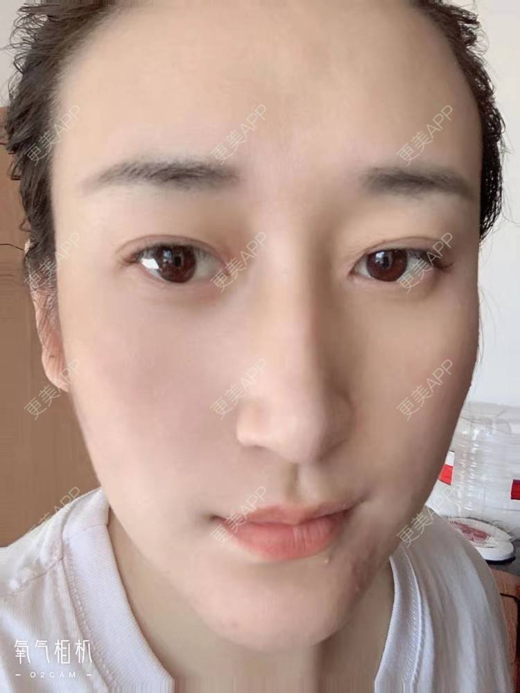 更美 - 更美用户ATliTAq8jn的内切去眼袋经验 | 北京 | 眶隔脂肪释放 | 射频去眼袋 | 内切去眼袋 | 激光去眼袋