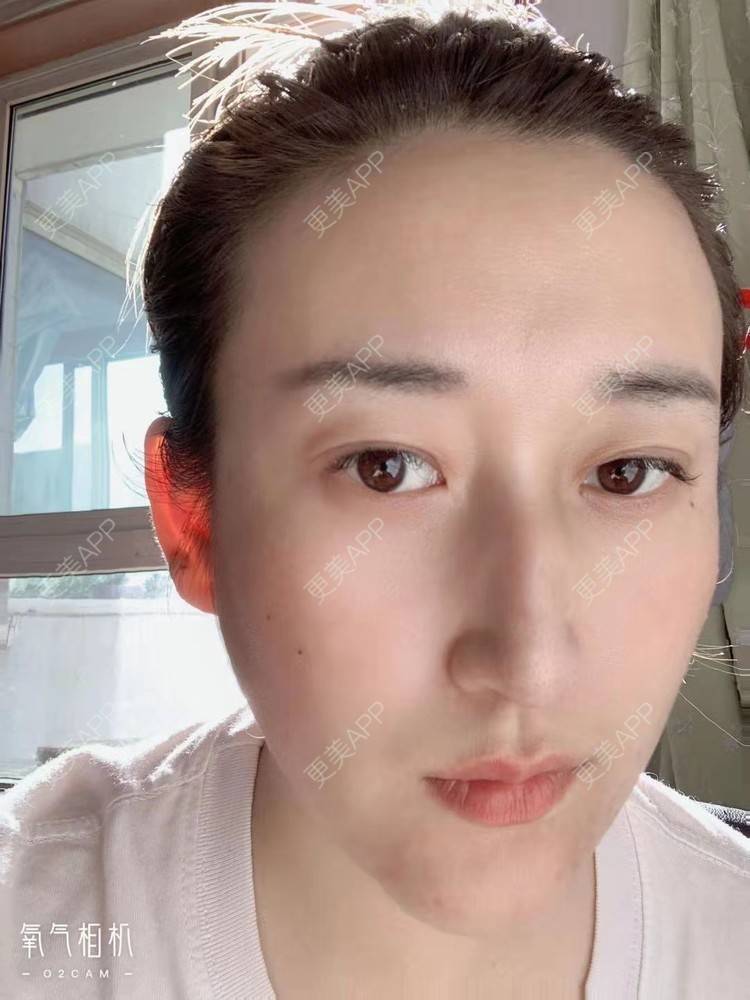 更美 - 更美用户ATliTAq8jn的内切去眼袋经验 | 北京 | 眶隔脂肪释放 | 射频去眼袋 | 内切去眼袋 | 激光去眼袋