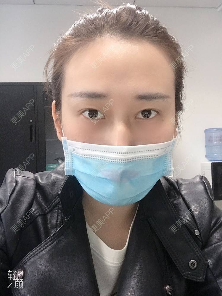 更美 - 更美用户ATliTAq8jn的内切去眼袋经验 | 北京 | 眶隔脂肪释放 | 射频去眼袋 | 内切去眼袋 | 激光去眼袋