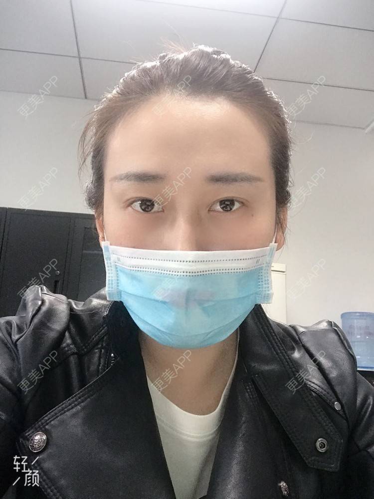 更美 - 更美用户ATliTAq8jn的内切去眼袋经验 | 北京 | 眶隔脂肪释放 | 射频去眼袋 | 内切去眼袋 | 激光去眼袋