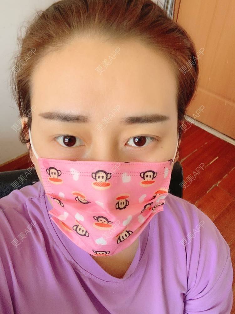 更美 - 更美用户ATliTAq8jn的内切去眼袋经验 | 北京 | 眶隔脂肪释放 | 射频去眼袋 | 内切去眼袋 | 激光去眼袋