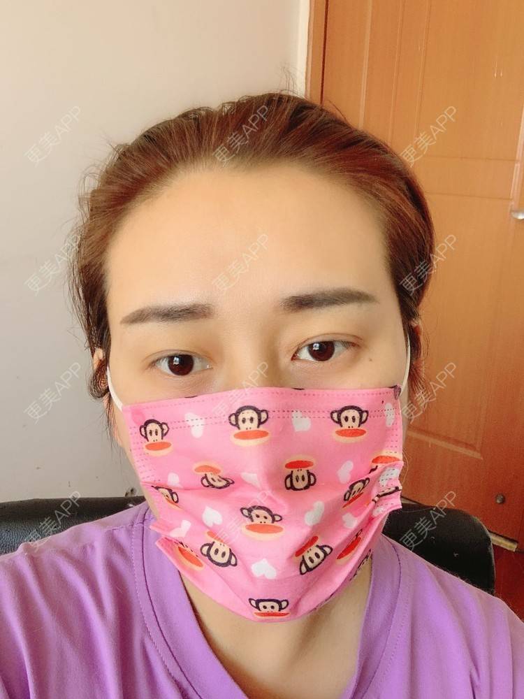 更美 - 更美用户ATliTAq8jn的内切去眼袋经验 | 北京 | 眶隔脂肪释放 | 射频去眼袋 | 内切去眼袋 | 激光去眼袋