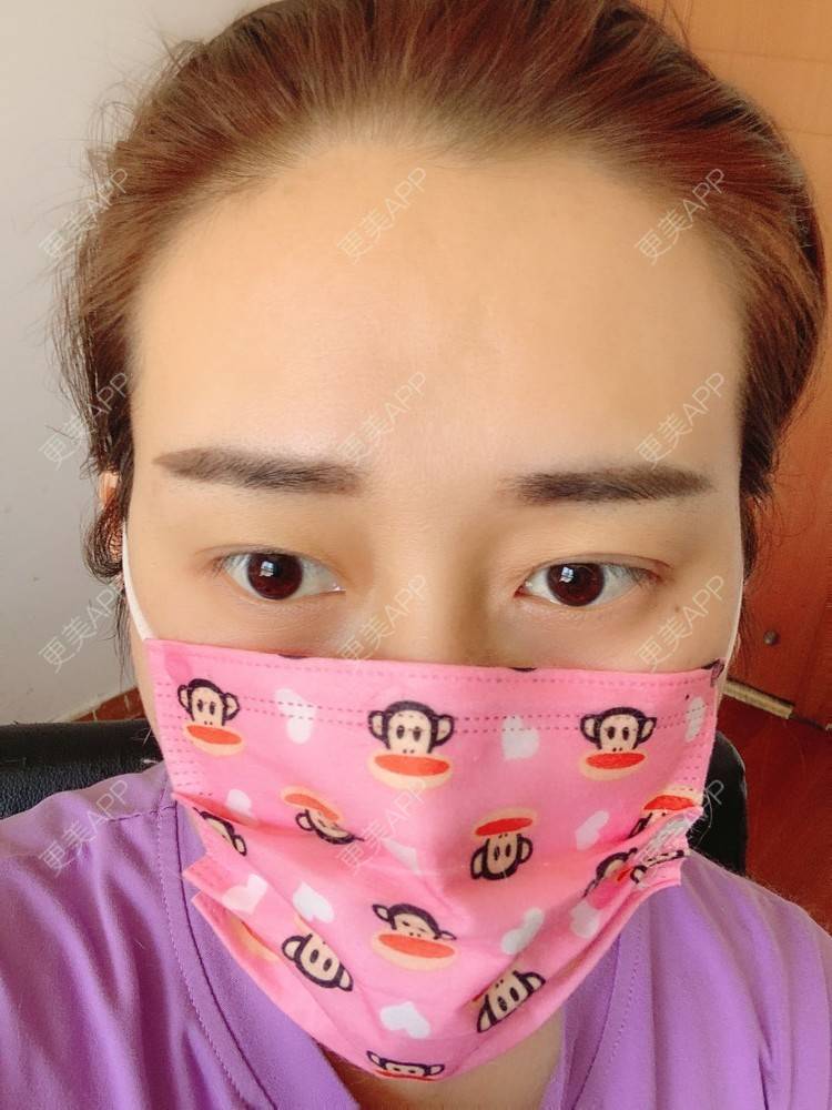 更美 - 更美用户ATliTAq8jn的内切去眼袋经验 | 北京 | 眶隔脂肪释放 | 射频去眼袋 | 内切去眼袋 | 激光去眼袋