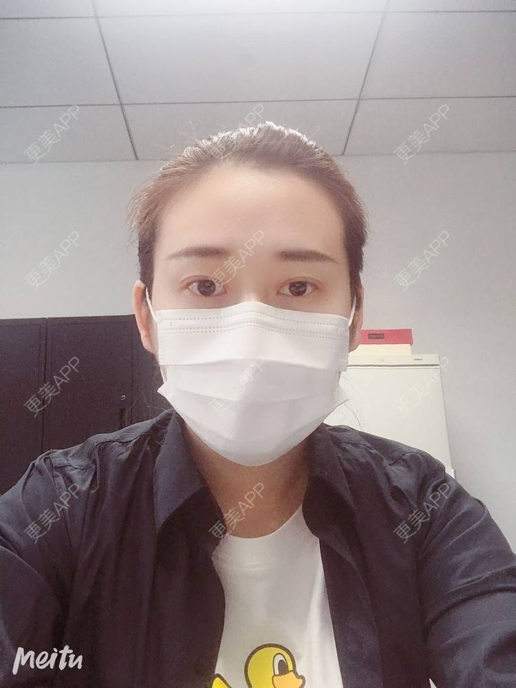 更美 - 更美用户ATliTAq8jn的内切去眼袋经验 | 北京 | 眶隔脂肪释放 | 射频去眼袋 | 内切去眼袋 | 激光去眼袋