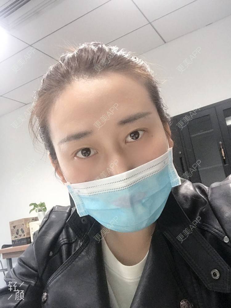 更美 - 更美用户ATliTAq8jn的内切去眼袋经验 | 北京 | 眶隔脂肪释放 | 射频去眼袋 | 内切去眼袋 | 激光去眼袋