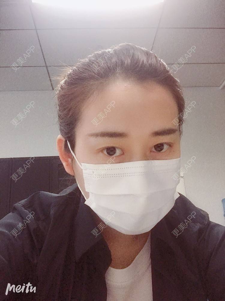 更美 - 更美用户ATliTAq8jn的内切去眼袋经验 | 北京 | 眶隔脂肪释放 | 射频去眼袋 | 内切去眼袋 | 激光去眼袋