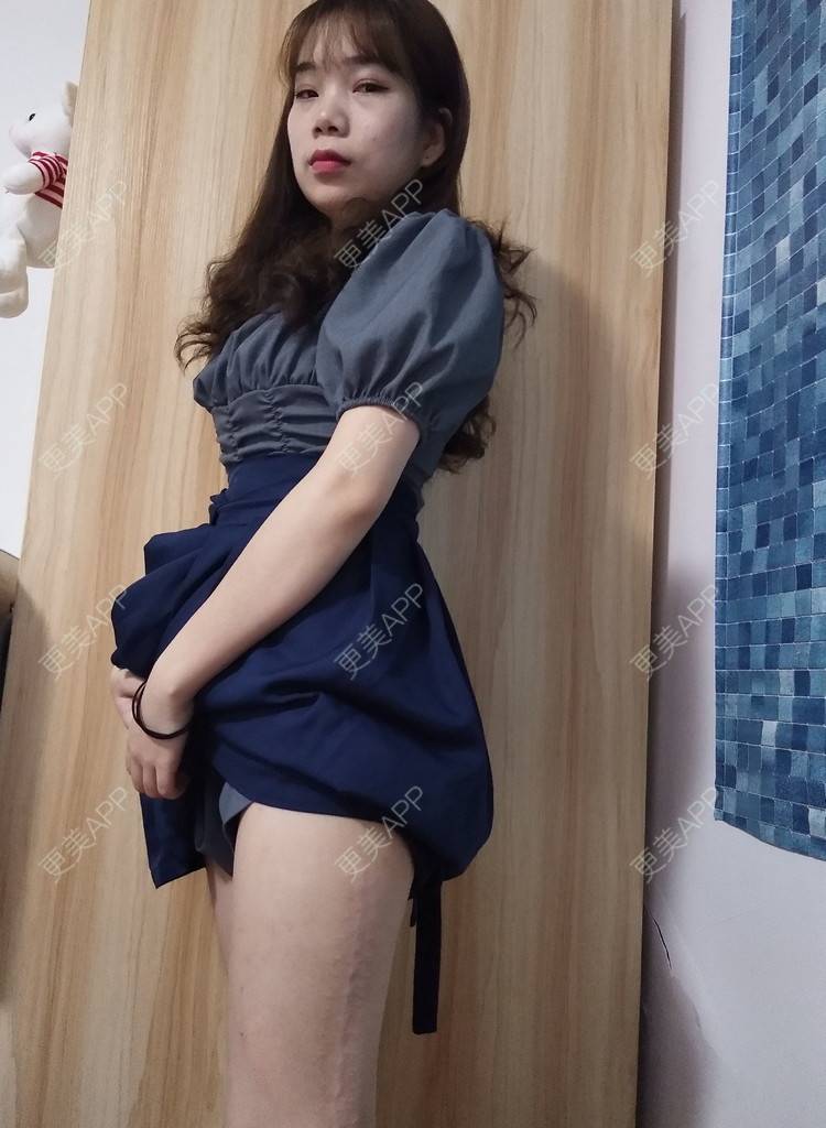 更美 - 更美用户wLCOFKdytM的激光淡疤经验 | 成都 | 皮肤综合管理套餐 | 综合淡疤 | 激光淡疤
