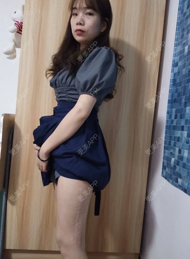 更美 - 更美用户wLCOFKdytM的激光淡疤经验 | 成都 | 皮肤综合管理套餐 | 综合淡疤 | 激光淡疤