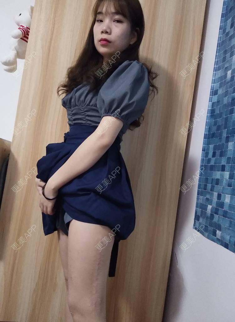 更美 - 更美用户wLCOFKdytM的激光淡疤经验 | 成都 | 皮肤综合管理套餐 | 综合淡疤 | 激光淡疤