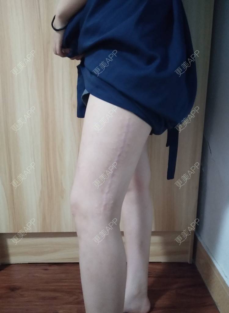 更美 - 更美用户wLCOFKdytM的激光淡疤经验 | 成都 | 皮肤综合管理套餐 | 综合淡疤 | 激光淡疤