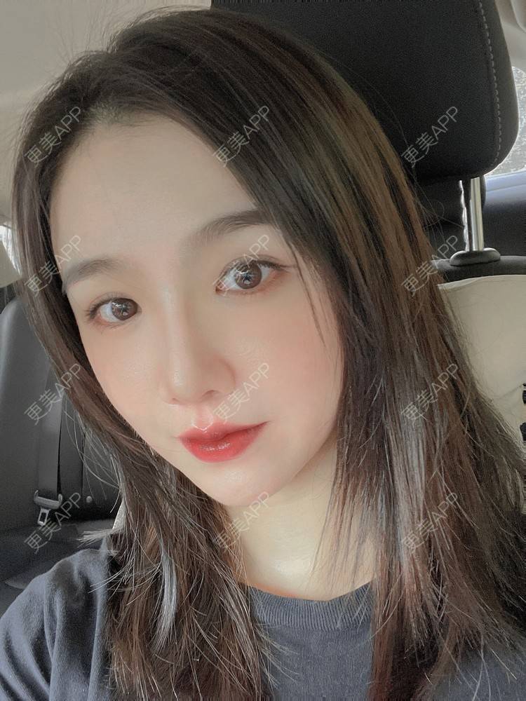 更美 - 陈陈子～的M唇成形经验 | 唇综合 | 自体脂肪全面部填充 | 深圳