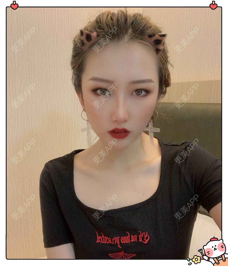 更美 - 更美用户C5Srbgl5fF的玻尿酸经验 | 玻尿酸套餐 | 玻尿酸 | 深圳