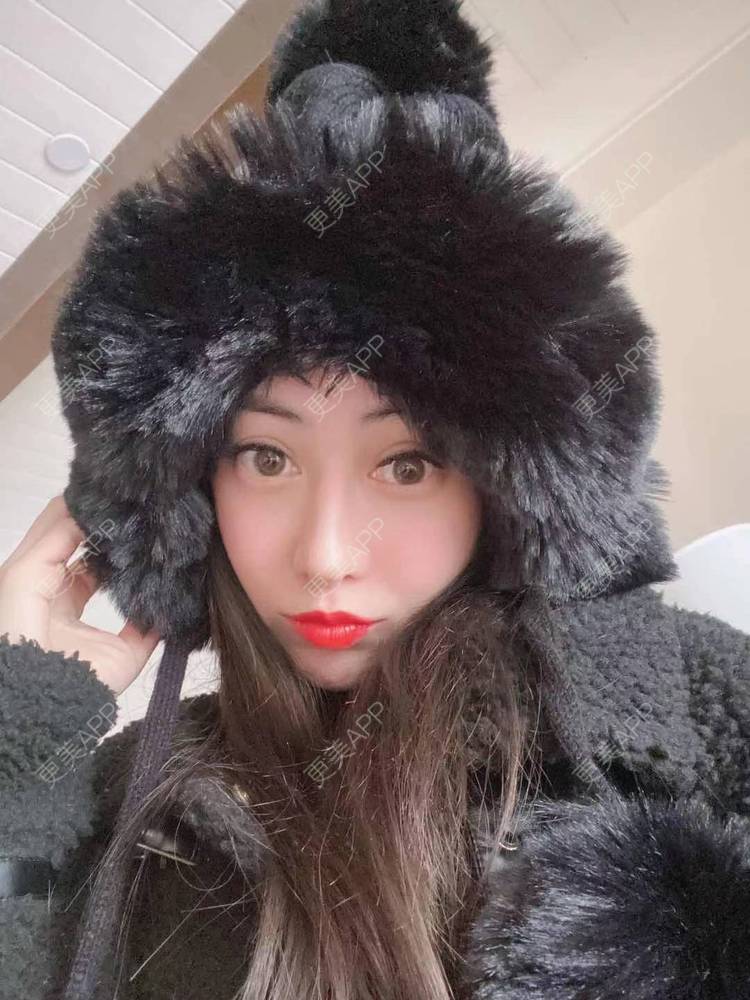 更美 - 大鱼海棠依旧的唇腭裂修复经验 | 唇腭裂修复 | 厚唇改薄 | 微笑唇手术 | 唇综合 | M唇成形