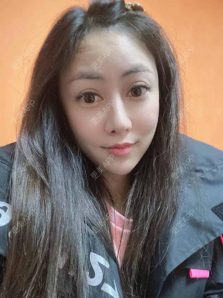 更美 - 大鱼海棠依旧的唇腭裂修复经验 | 唇腭裂修复 | 厚唇改薄 | 微笑唇手术 | 唇综合 | M唇成形