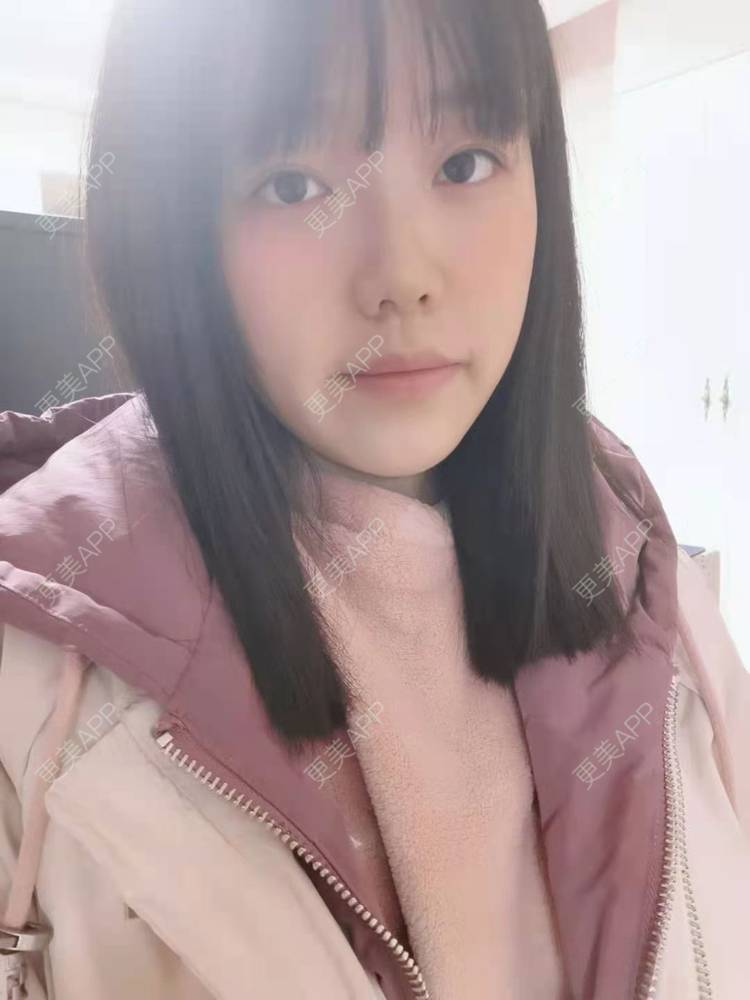 更美 - 甜心女孩不说的祛眼袋经验 | 内切去眼袋 | 外切去眼袋 | 眶隔脂肪释放 | 激光去眼袋 | 射频去眼袋 | 祛眼袋