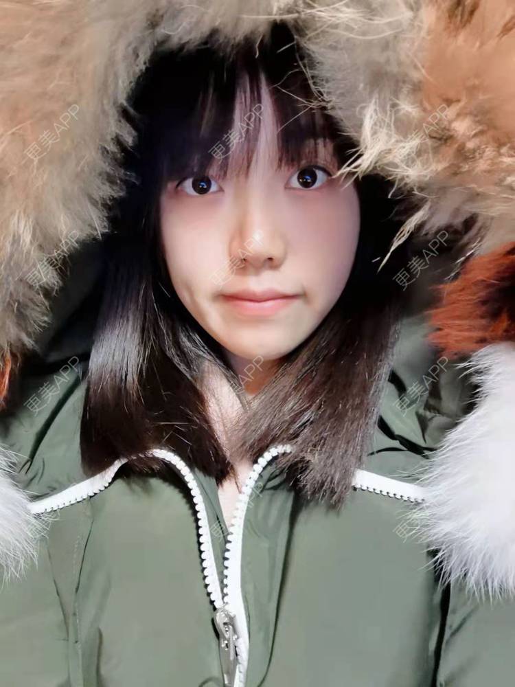 更美 - 甜心女孩不说的祛眼袋经验 | 内切去眼袋 | 外切去眼袋 | 眶隔脂肪释放 | 激光去眼袋 | 射频去眼袋 | 祛眼袋