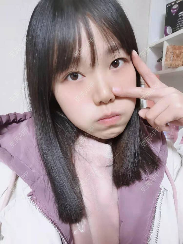 更美 - 甜心女孩不说的祛眼袋经验 | 内切去眼袋 | 外切去眼袋 | 眶隔脂肪释放 | 激光去眼袋 | 射频去眼袋 | 祛眼袋