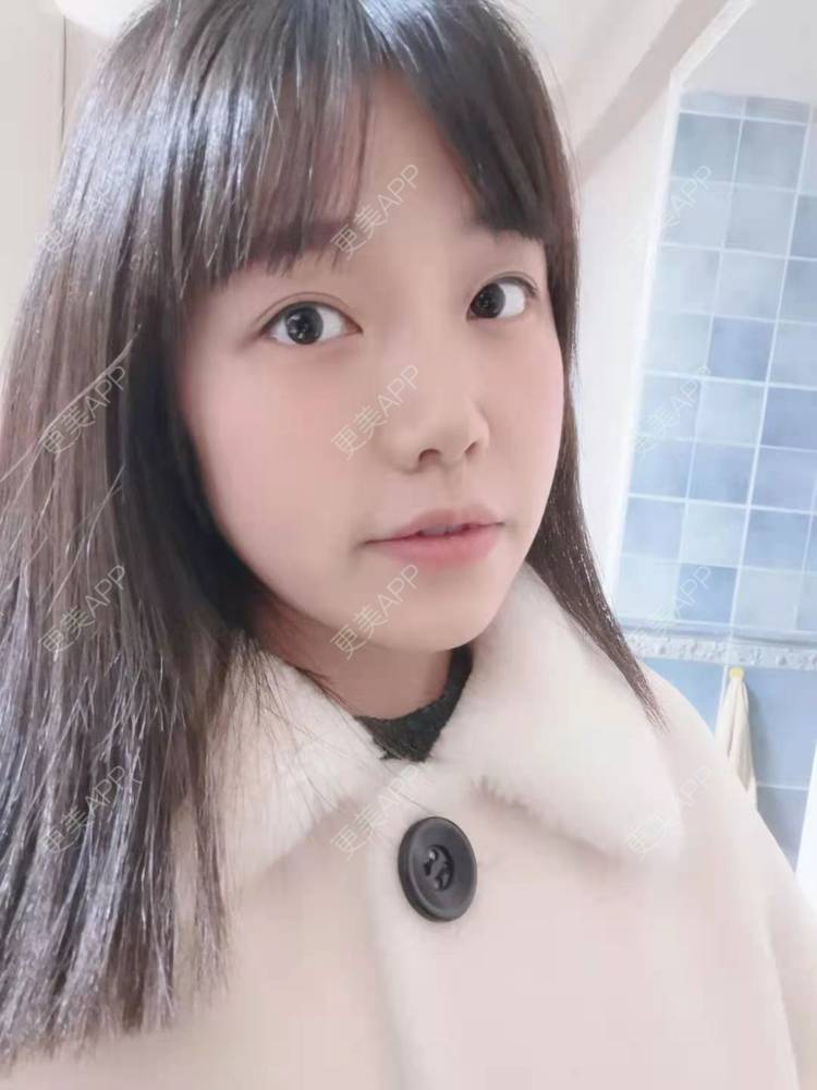 更美 - 甜心女孩不说的祛眼袋经验 | 内切去眼袋 | 外切去眼袋 | 眶隔脂肪释放 | 激光去眼袋 | 射频去眼袋 | 祛眼袋
