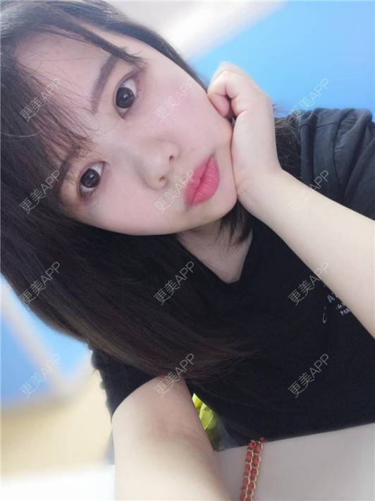 更美 - 更美用户UBFP1Yz4W2的开外眼角经验 | 开外眼角 | 郑州