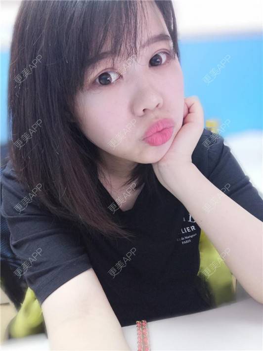 更美 - 更美用户UBFP1Yz4W2的开外眼角经验 | 开外眼角 | 郑州