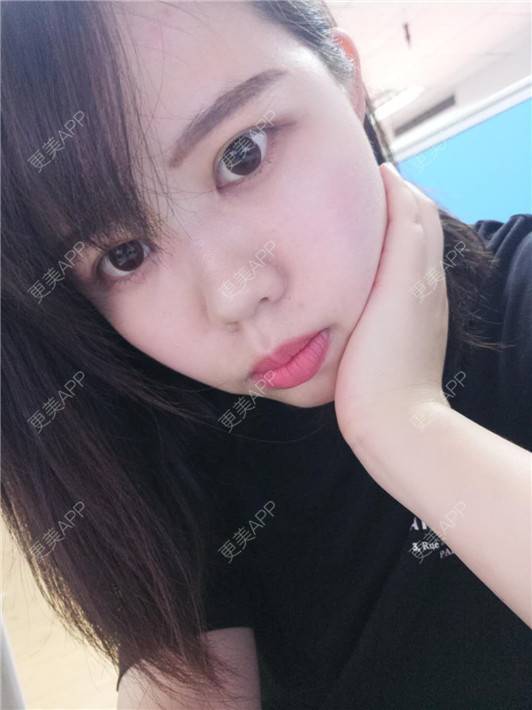 更美 - 更美用户UBFP1Yz4W2的开外眼角经验 | 开外眼角 | 郑州