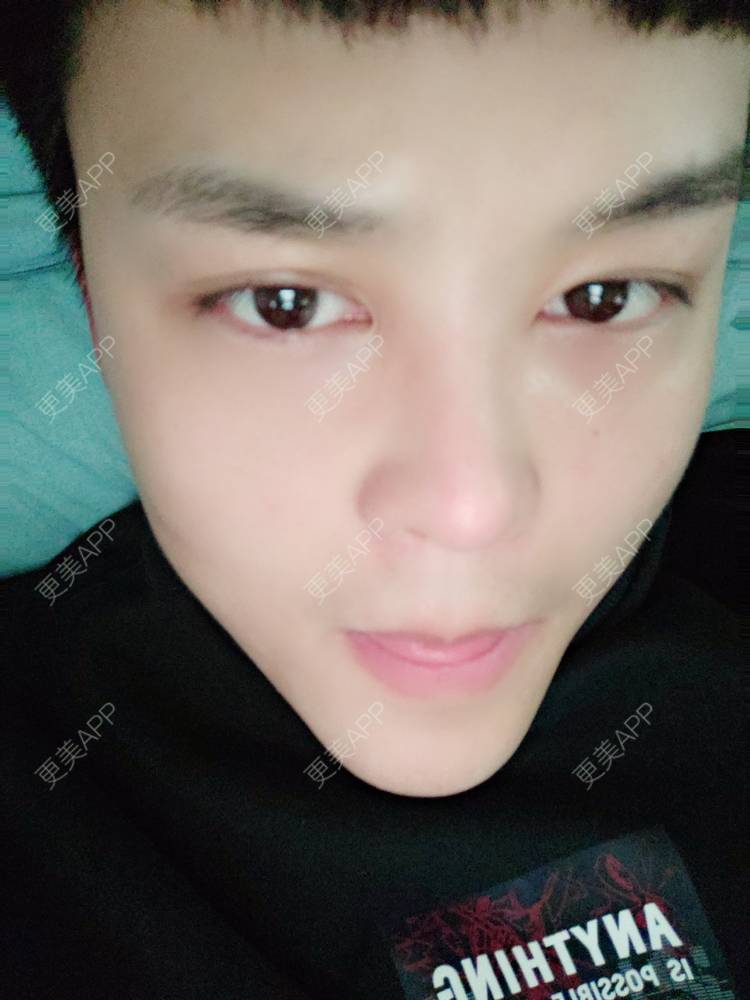 更美 - Mr🐔哦啦啦的隆鼻经验 | 隆鼻 | 鼻部多项 | 重庆