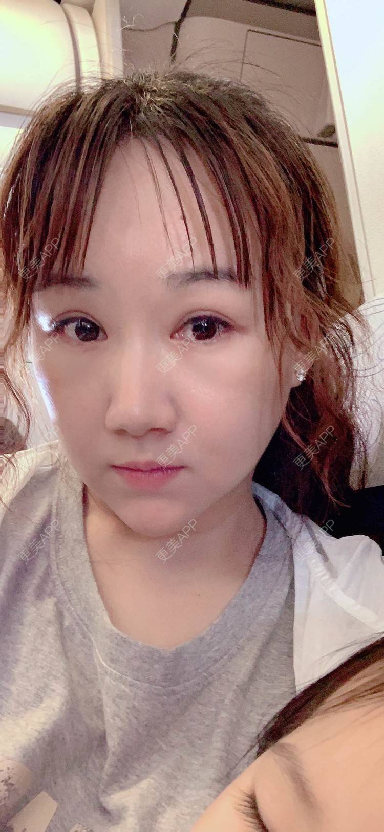 更美 - 小霉霉的光纤溶脂经验 | 北京 | 光纤溶脂