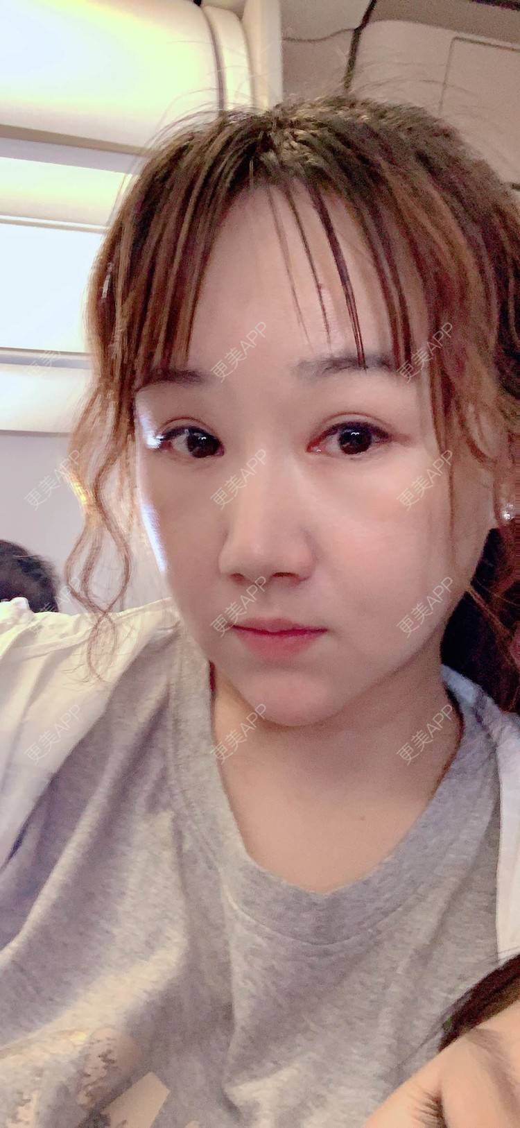 更美 - 小霉霉的光纤溶脂经验 | 北京 | 光纤溶脂