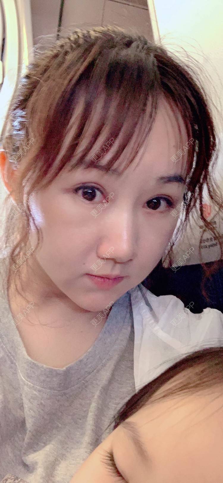 更美 - 小霉霉的光纤溶脂经验 | 北京 | 光纤溶脂