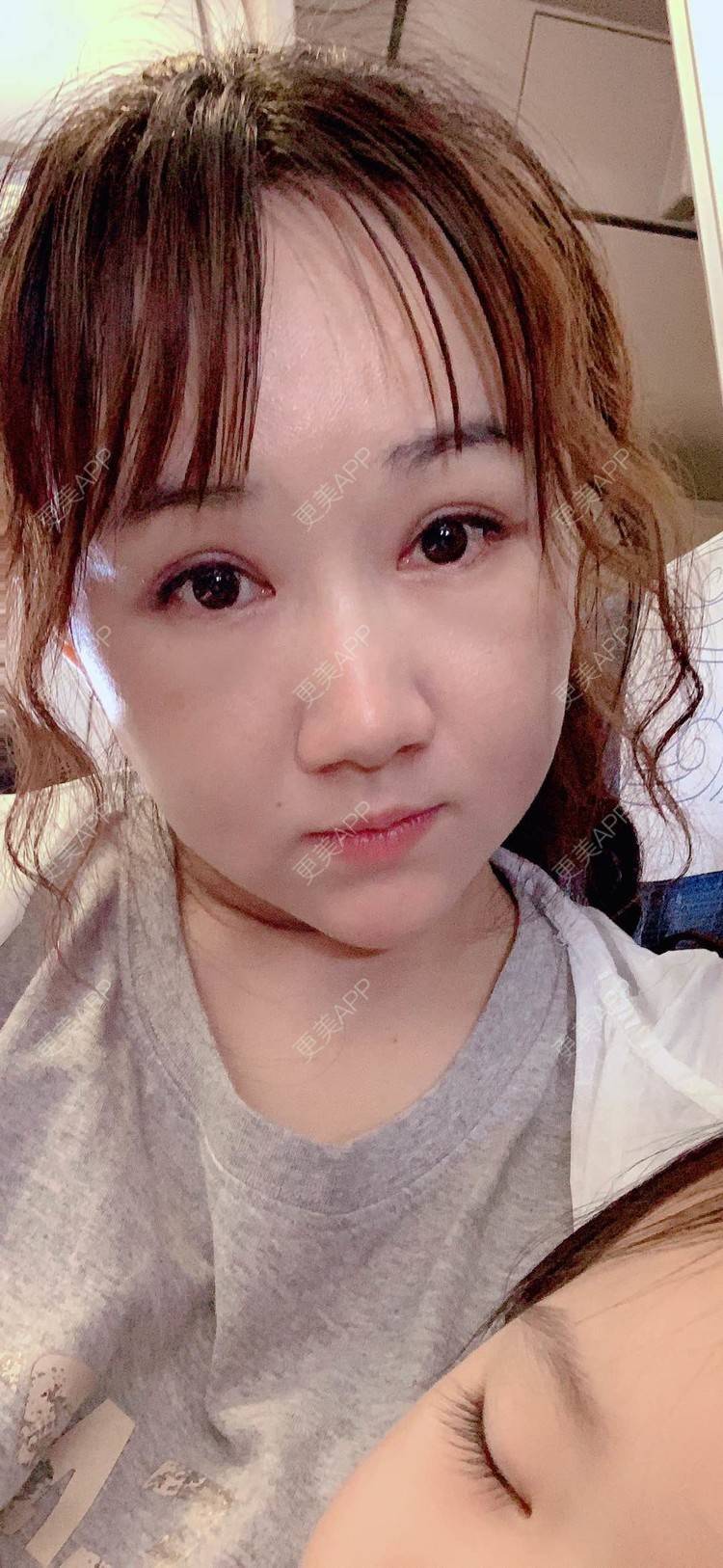 更美 - 小霉霉的光纤溶脂经验 | 北京 | 光纤溶脂