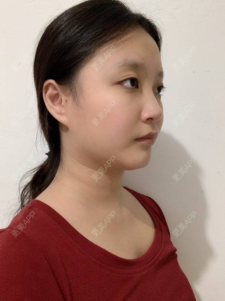 更美 - 更美用户Va16hBOpme的颧弓降低经验 | 郑州 | 颧弓降低