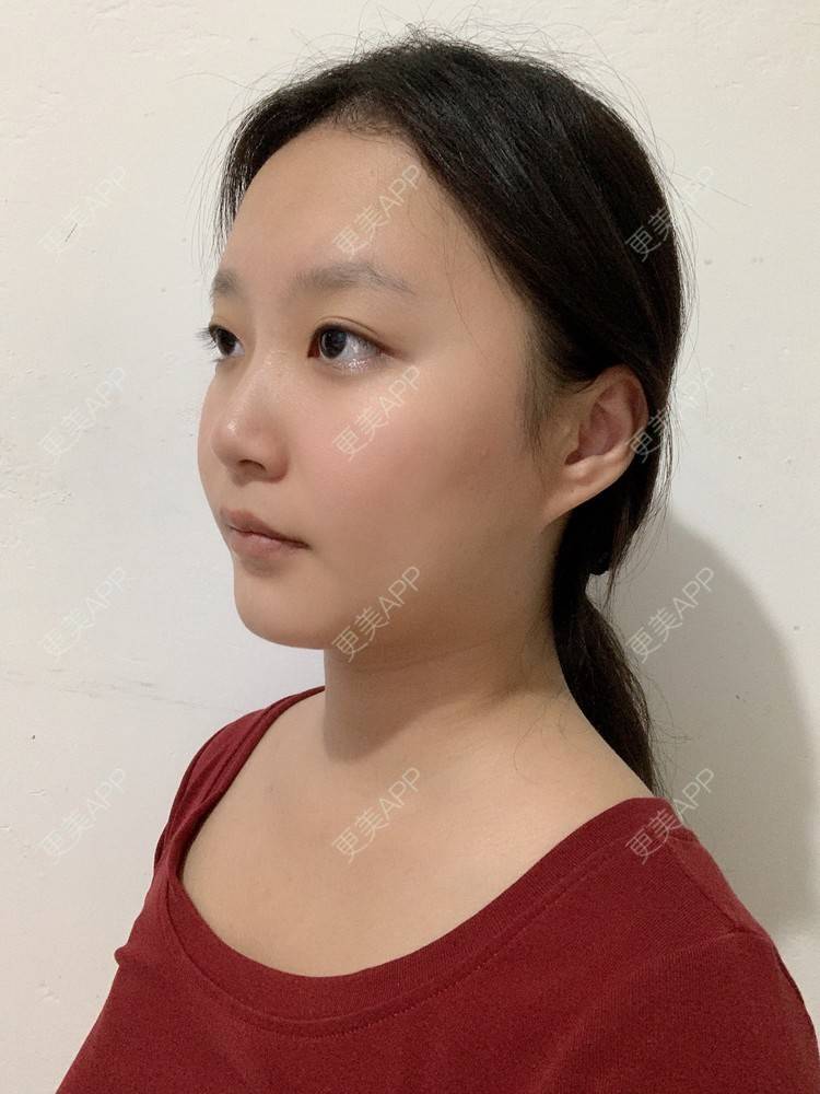 更美 - 更美用户Va16hBOpme的颧弓降低经验 | 郑州 | 颧弓降低