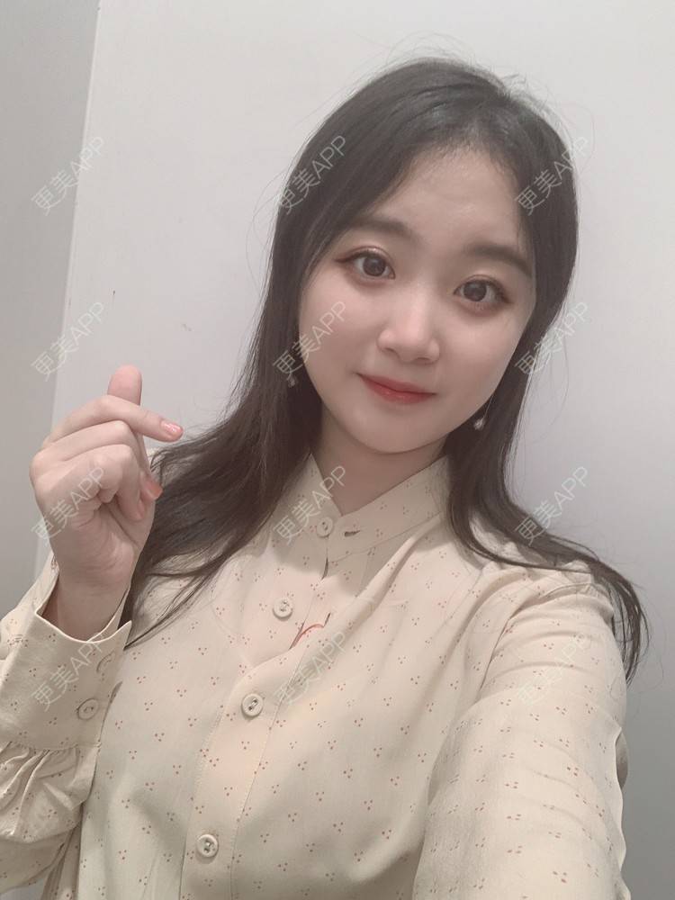 更美 - 更美用户Va16hBOpme的颧弓降低经验 | 郑州 | 颧弓降低