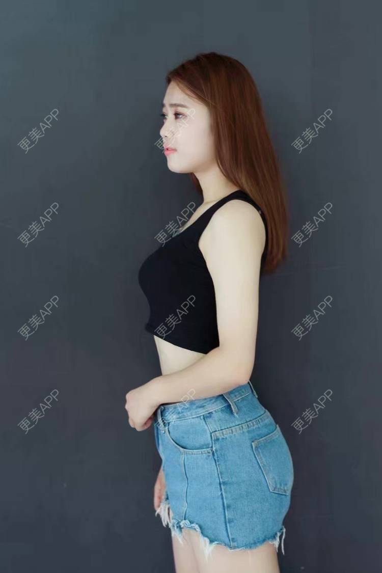 更美 - 等风啊熊抱啊的埋线提升经验 | 北京 | 埋线提升