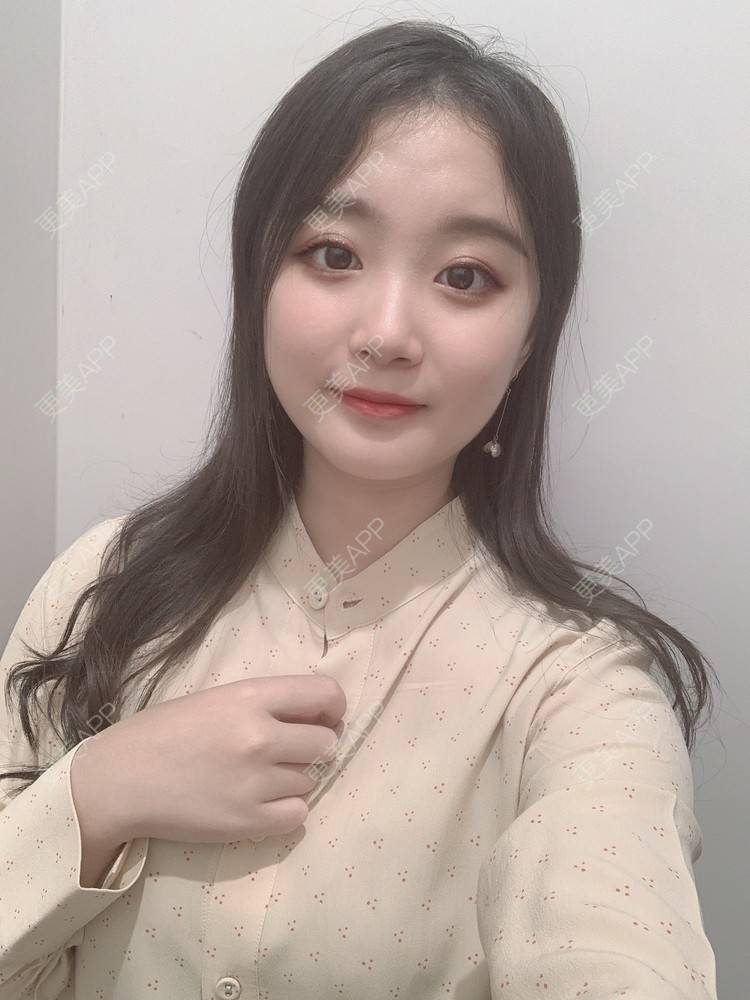更美 - 更美用户Va16hBOpme的颧弓降低经验 | 郑州 | 颧弓降低