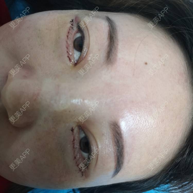 更美 - 更美用户8Z3nsQztj2的综合去眼袋经验 | 外切去眼袋 | 综合去眼袋 | 深圳